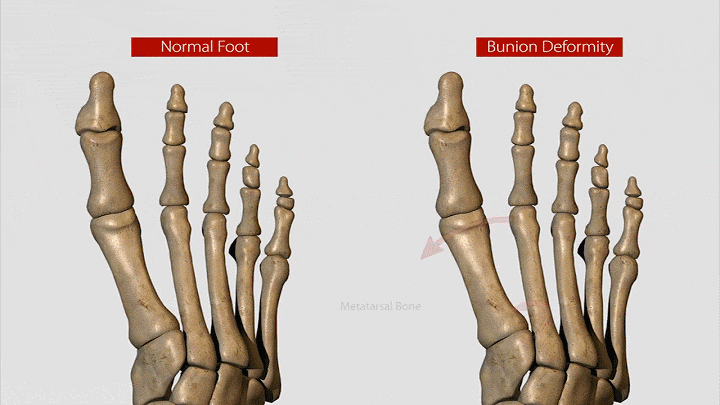 Lapiplasty-at-WVU-Medicine_-A-Revolutionary-Approach-to-Bunion-Surgery202024850221.gif