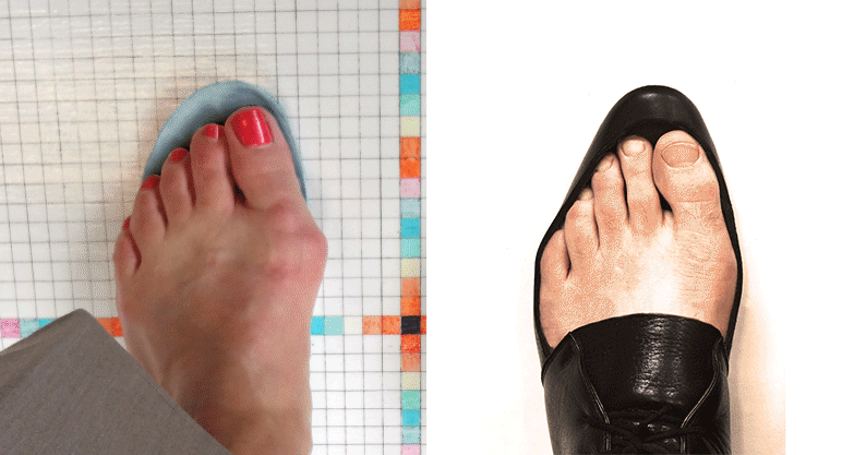 Bunion_1.gif