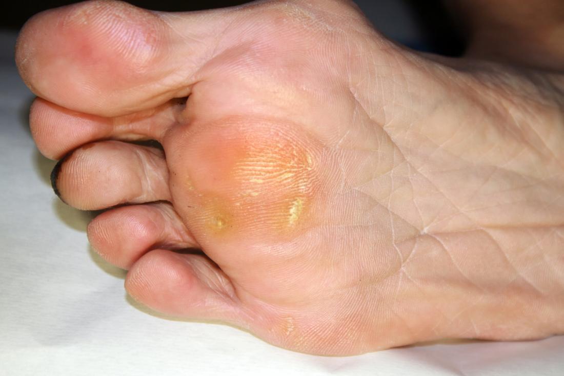 corns-foot.jpg