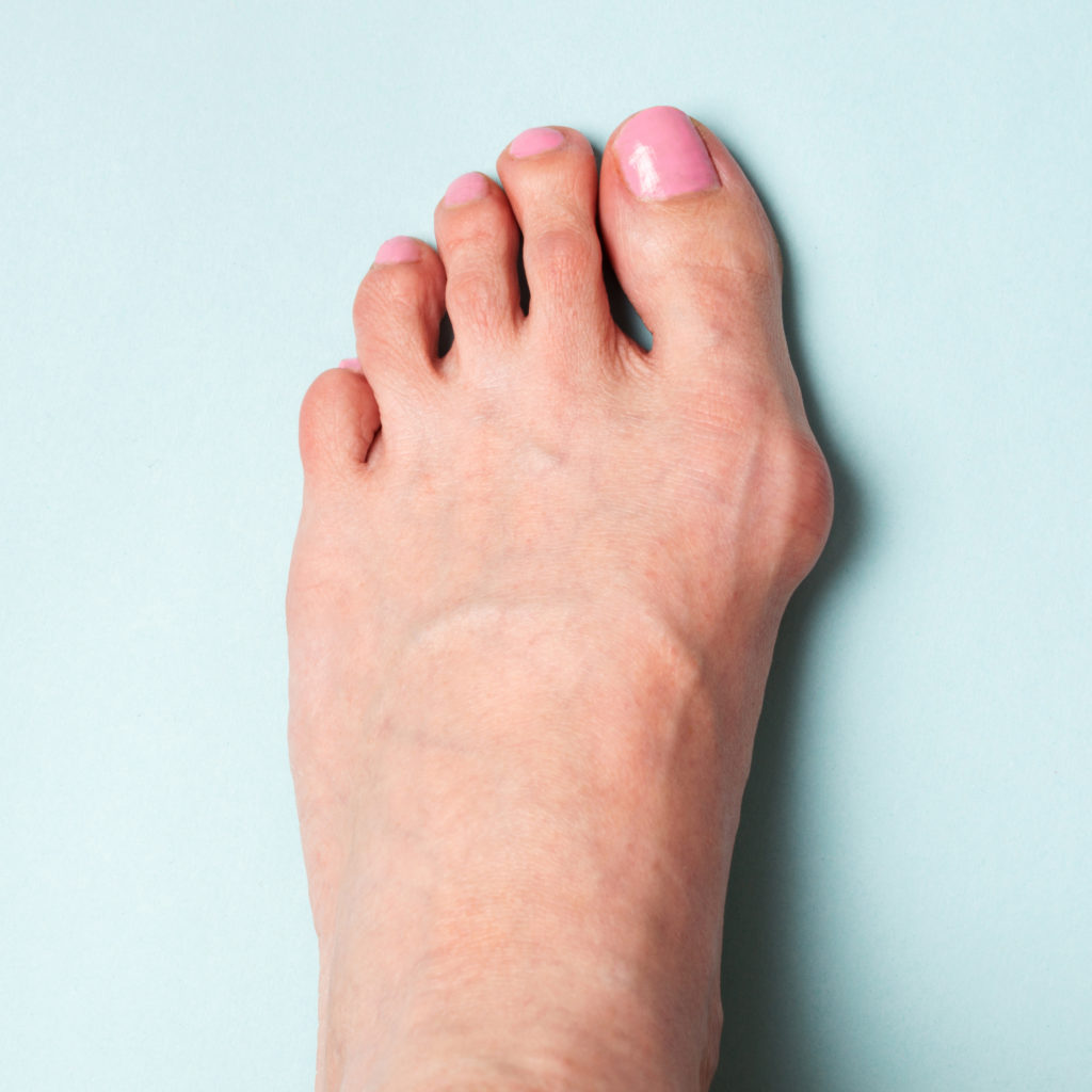 “bunion”的图片搜索结果"