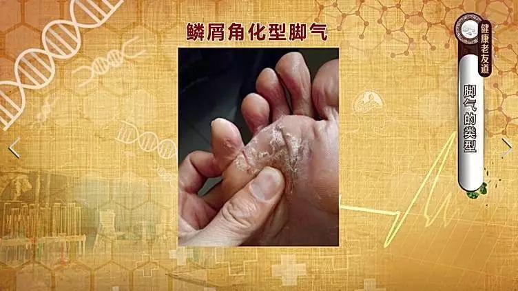 角化.jpg
