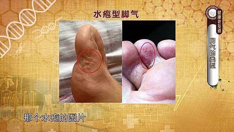 水疱.jpg