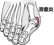 MUS_bunion.jpg
