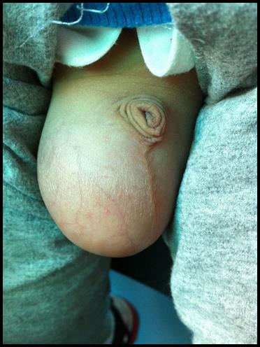 儿童睾丸疝气症状图片图片