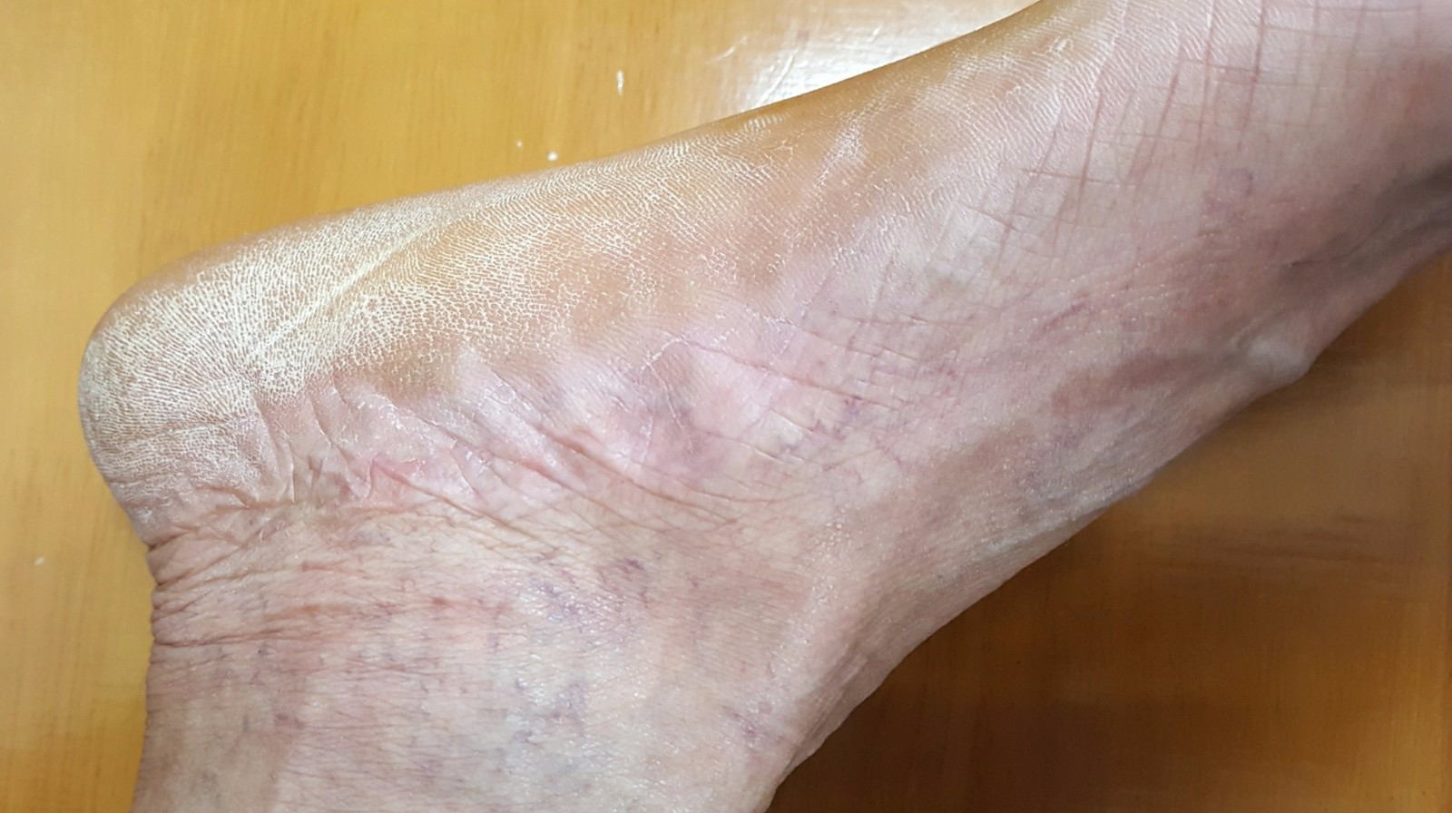 得了"顽癣"怎么办?-健康160