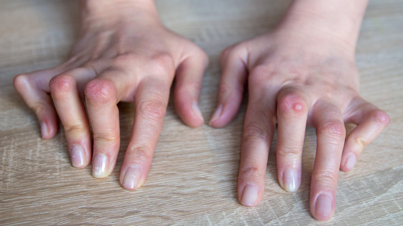 dt_200129_rheumatoid_arthritis_800x450.jpg