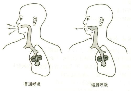 关于吸气肌肌力训练方式有很多,比如说使用阻力呼吸器训练吸气肌,另外