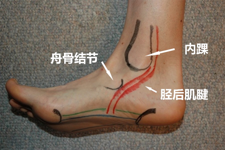 胫后肌腱图例2.jpg