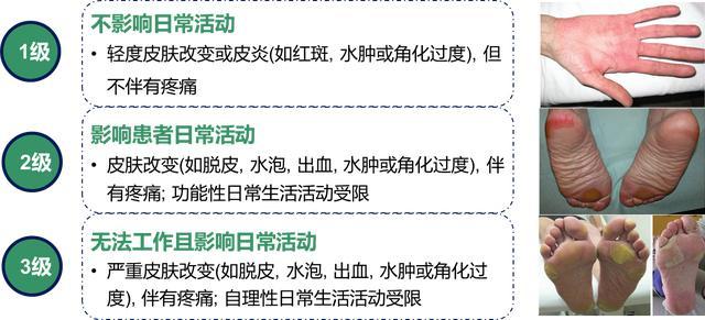 疫情期间肝癌的靶向治疗