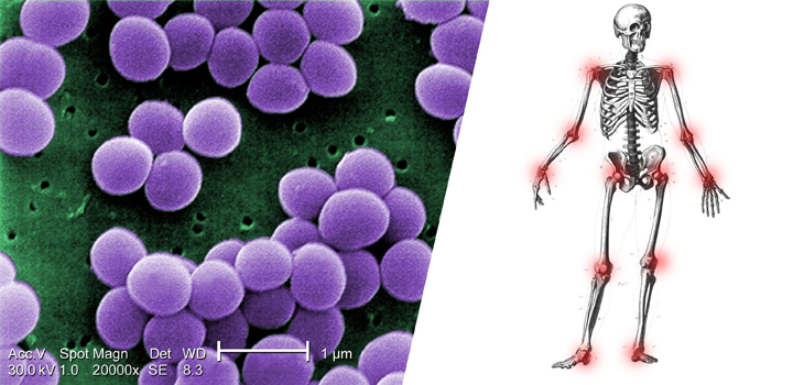 Bacterial_StaphylococcusAureusHumanSkeletonsJointhighlighted_WEB.jpg