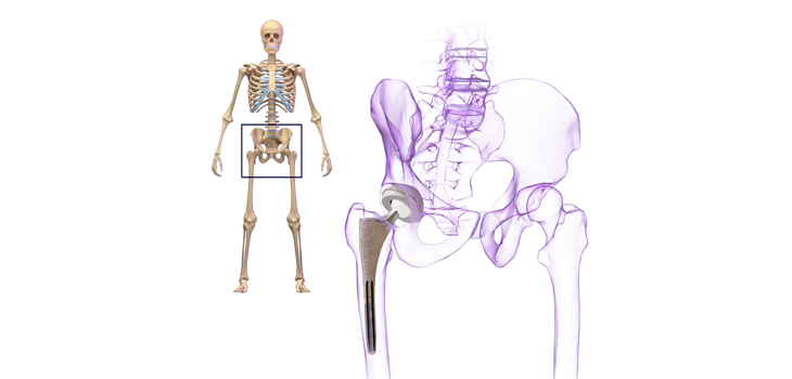 HowDoesTHA_HipReplacement_WEB.jpg