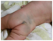 6,蒙古斑:新生宝宝躯干,臀部,四肢有些青色斑,为特殊色素细胞沉着所致