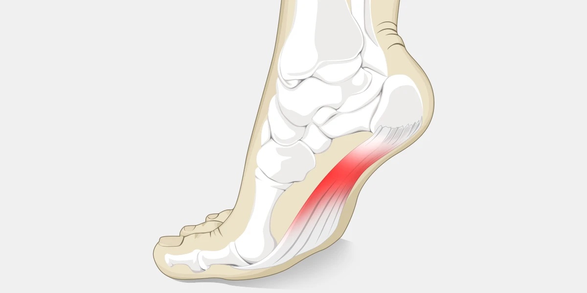 Arc-Pain-Illustration.jpg