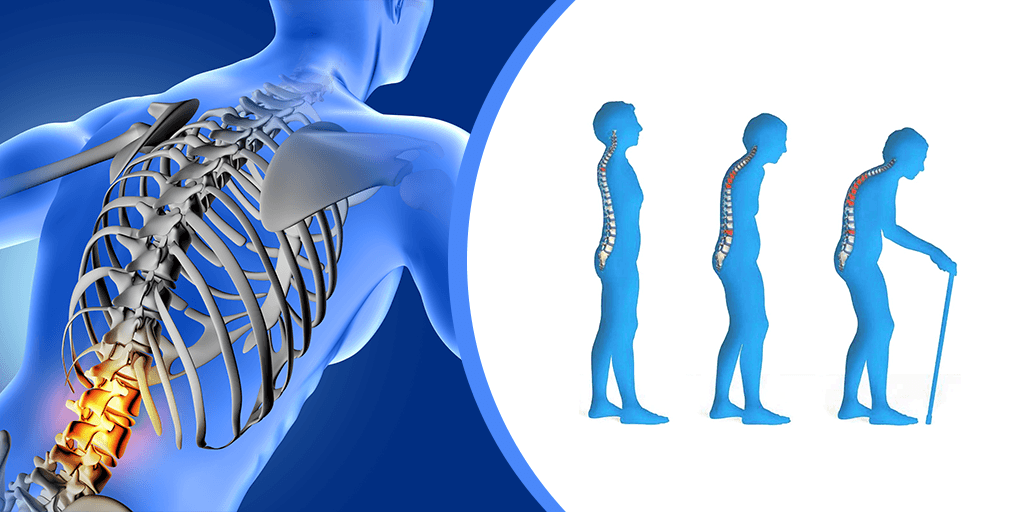 Osteoporosis.png