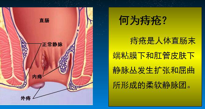 痔疮.png