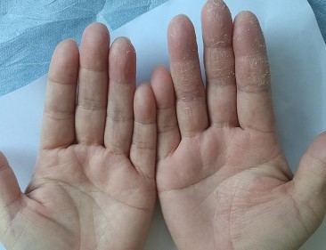 手部慢性湿疹反复发作时应该注意的几点事项