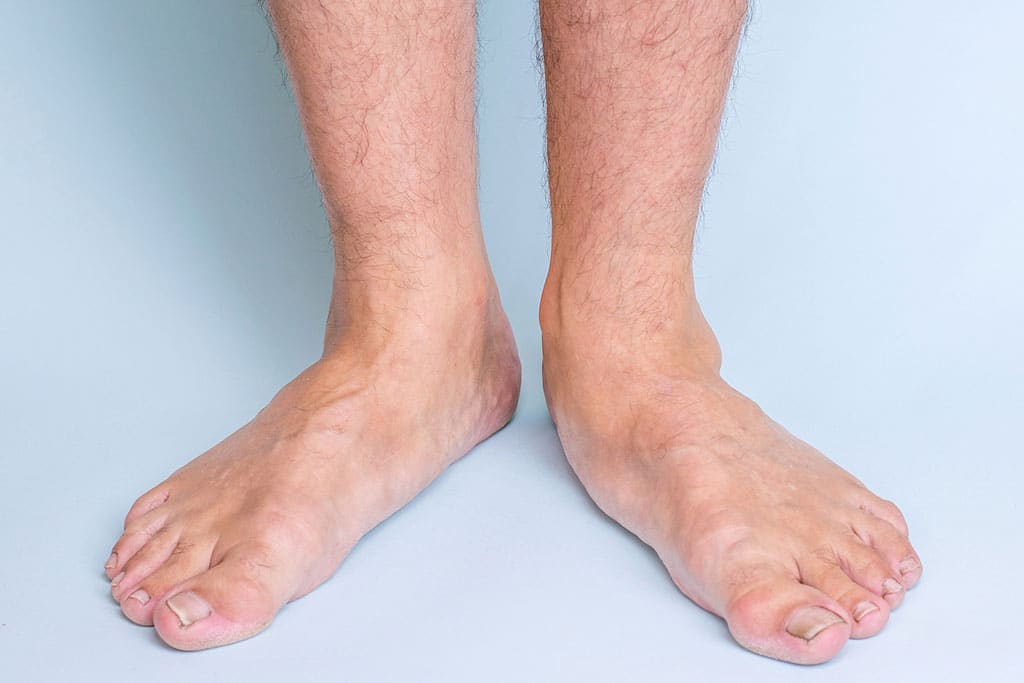 sole-podiatry-sports-podiatry-conditions-flat-feet.jpg