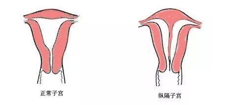 子宫中间多了个隔层，妇产科医生回复：怀孕没问题！
