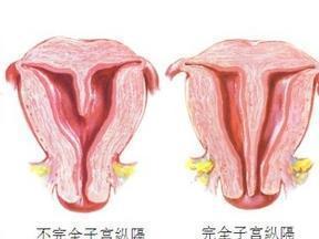 子宫中间多了个隔层，妇产科医生回复：怀孕没问题！