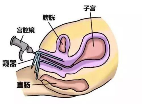 子宫中间多了个隔层，妇产科医生回复：怀孕没问题！