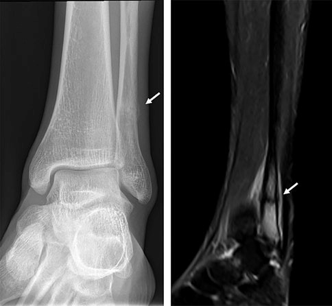 Stress-fracture-of-the-distal-fibula-a-Conventional-coronal-radiograph-demonstrating.jpg
