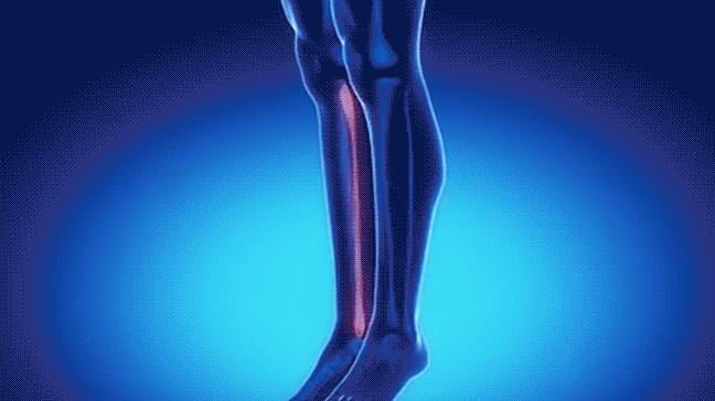 Fibula-Fracture-1.gif
