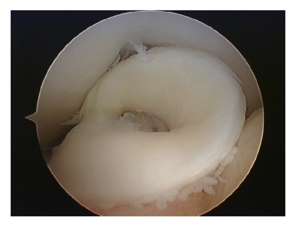 Displaced-bucket-handle-tear-of-the-medial-meniscus-a-Coronal-T2-FSE-Fat-Sat-MRI-shows.png