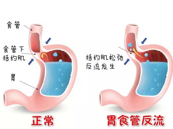 胃食道反流 2.jpg
