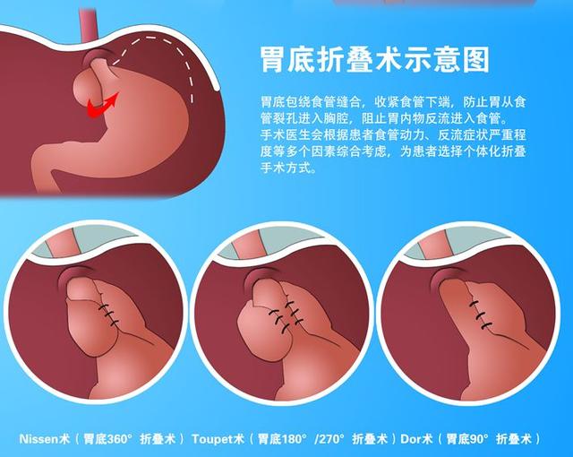 胃底折叠术.jpg