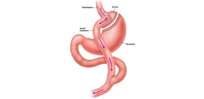 gastrik-bypass.jpg