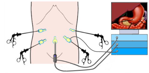 laparoscopic surgery.png