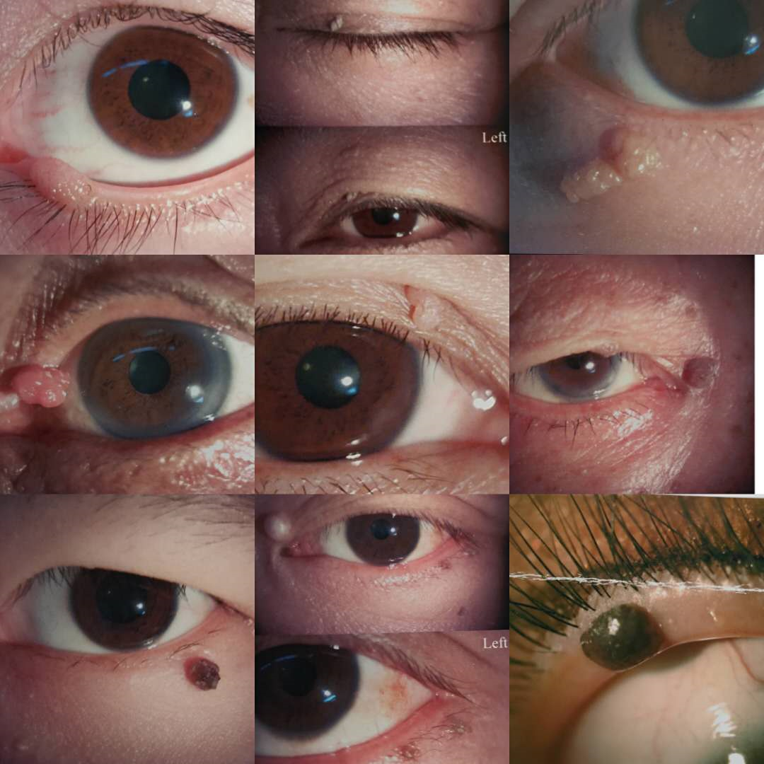 眼旁小疙瘩眼睑肿物要怎么办