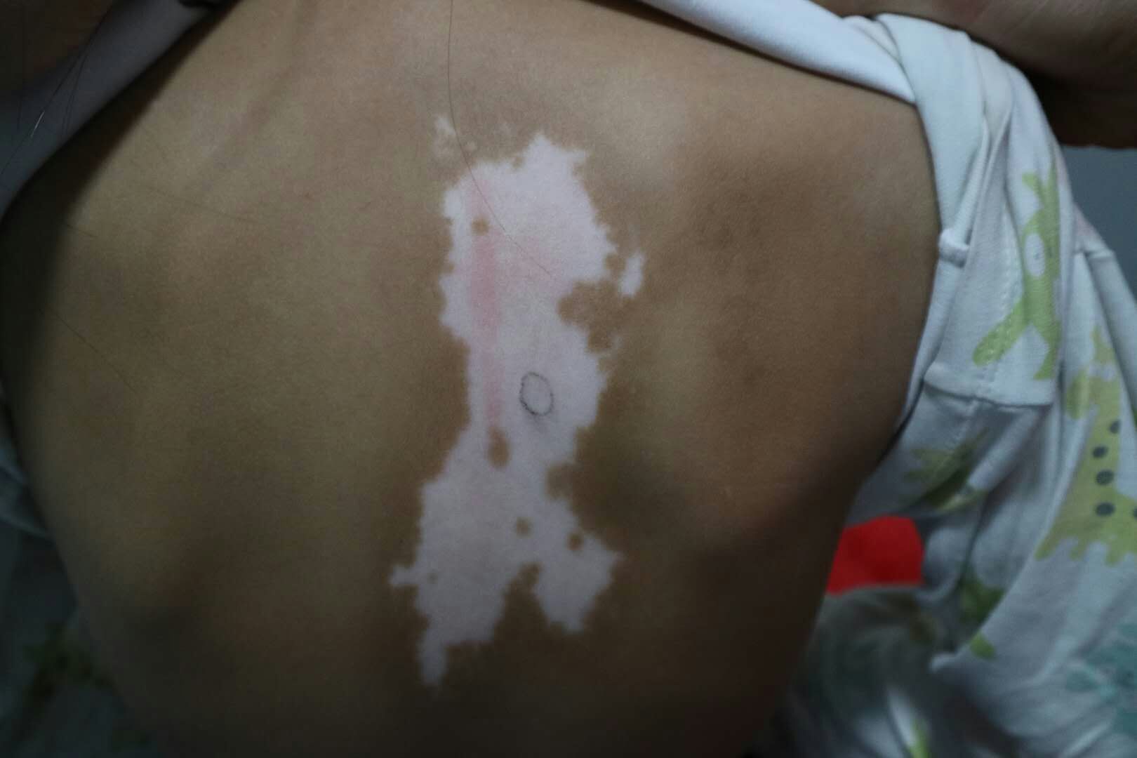 晕痣白癜风