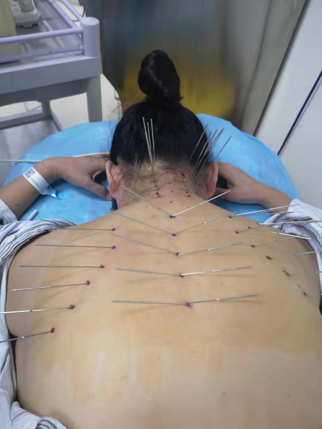 温经散寒祛风湿内热针导热疗法