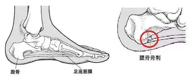 跟痛症.jpg