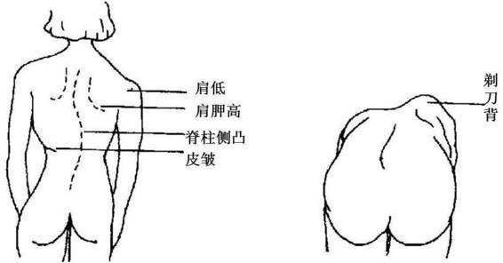 名医专访 | 深圳市龙华区人民医院张昊:脊柱畸形诊断与治疗
