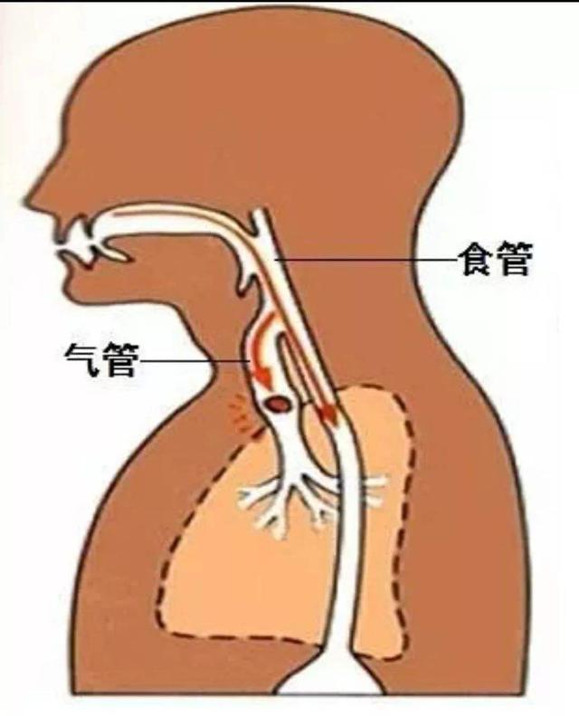 家中有人每天用胃管打餐吗？关于“误吸”你有必要知道多一些