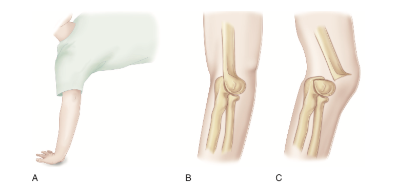 伸直型肱骨髁上骨折图片