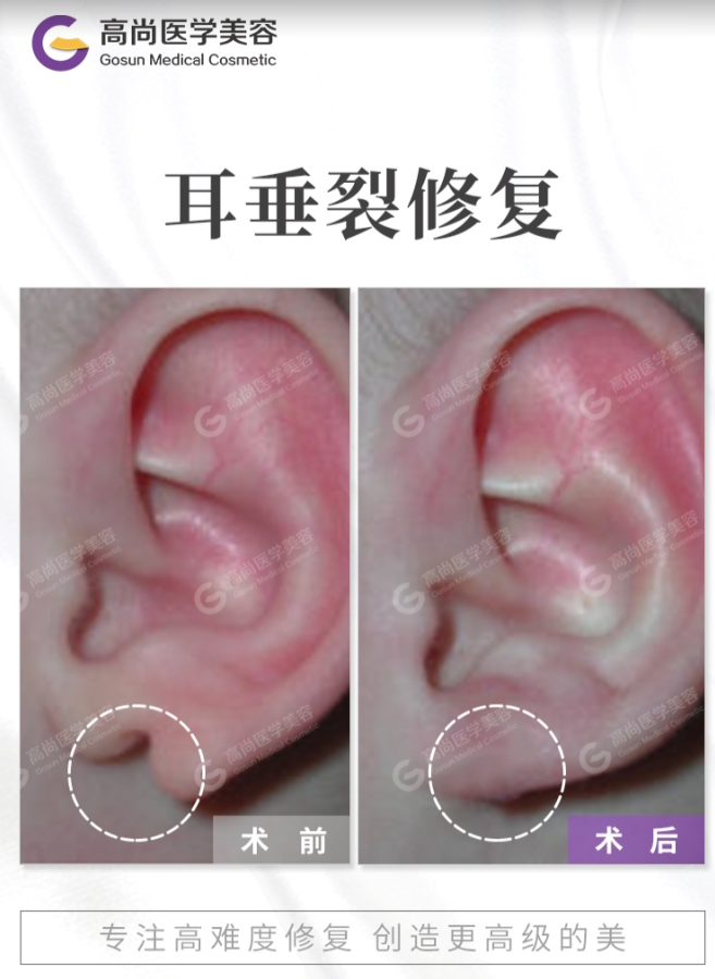 整形博士余文林:耳垂畸形的5种耳垂整形手术方法