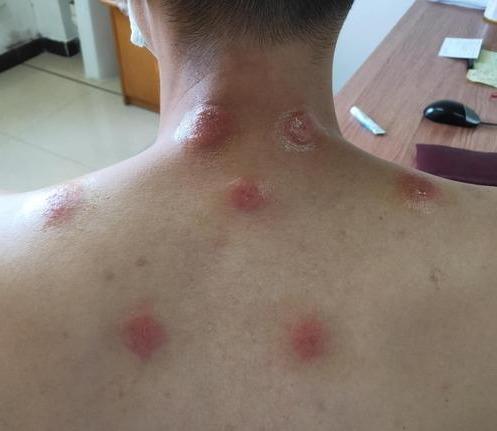 贴天灸后出现红肿、水疱，伴瘙痒、灼痛怎么办？