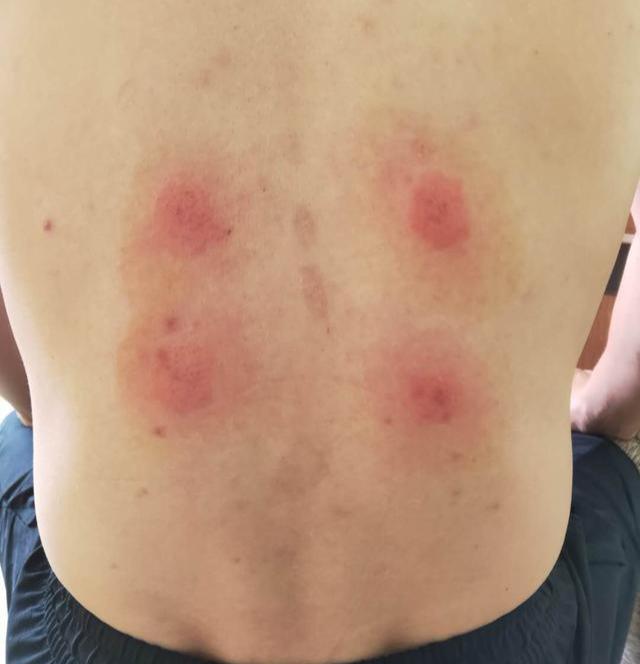贴天灸后出现红肿、水疱，伴瘙痒、灼痛怎么办？