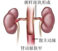 肾动脉狭窄.jpg