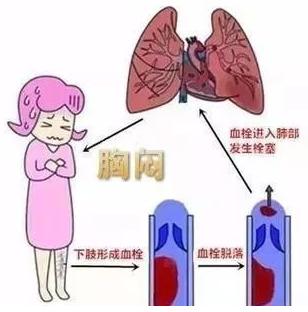 名医专访 | 深圳市罗湖区人民医院黄智勇：什么是深静脉血栓？
