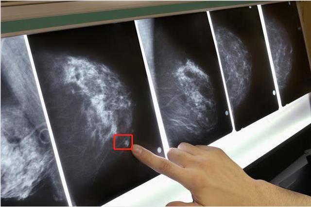 89岁男性得乳腺癌全切左乳！医生：男性也会得乳腺癌，有3大症状
