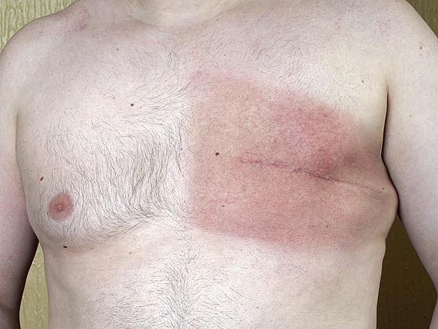 89岁男性得乳腺癌全切左乳！医生：男性也会得乳腺癌，有3大症状