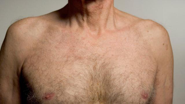 89岁男性得乳腺癌全切左乳！医生：男性也会得乳腺癌，有3大症状