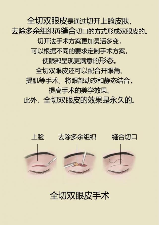 我适合做双眼皮手术吗？