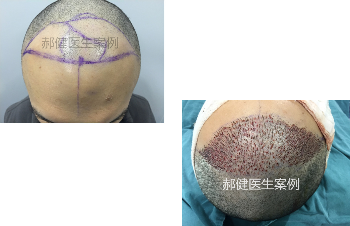 1596865125430416.jpg 植发.jpg
