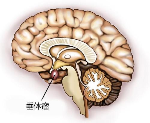 47岁男性同房需求剧增，吓坏妻子，一查竟是脑肿瘤在搞鬼