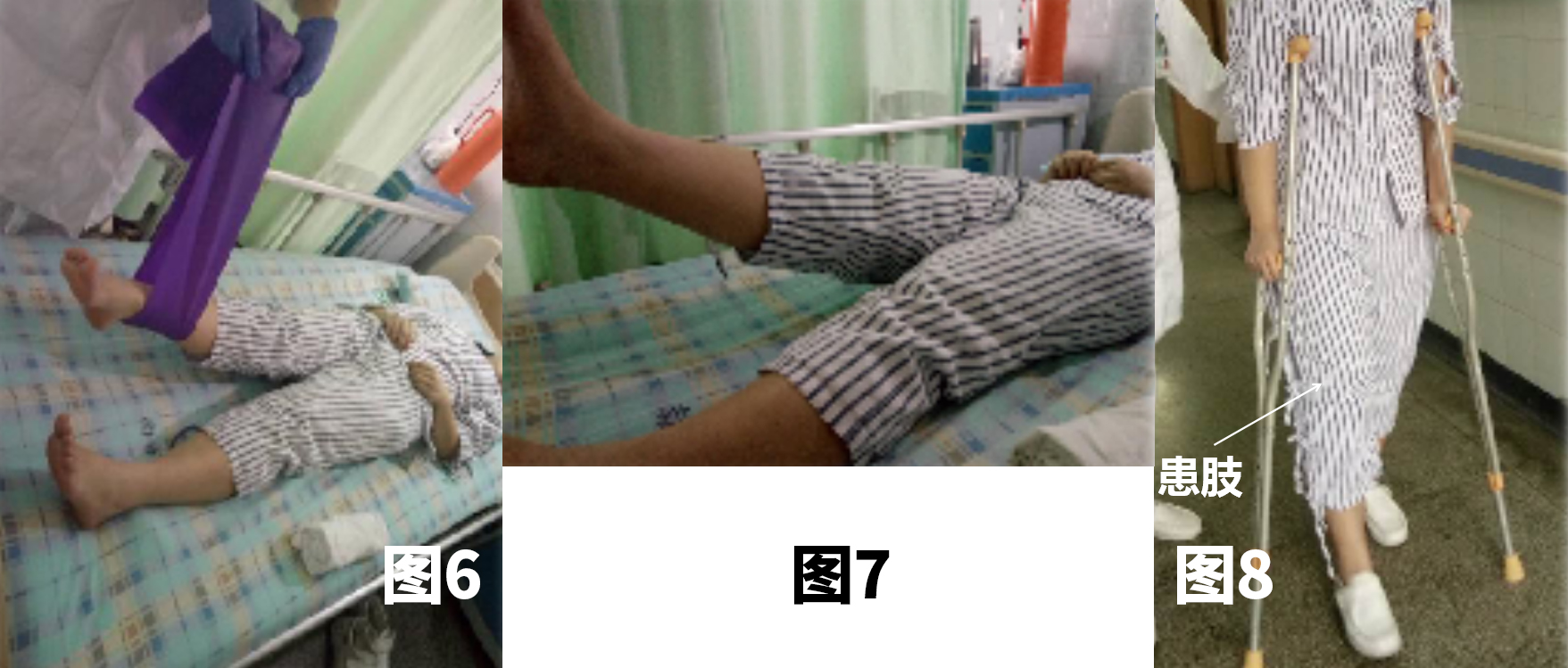 <!--HAODF:8:rengongguanjiezhihuanshu-->关节置换<!--HAODF:/8:rengongguanjiezhihuanshu-->的康复很重要：髋<!--HAODF:8:rengongguanjiezhihuanshu-->关节置换<!--HAODF:/8:rengongguanjiezhihuanshu-->手术后平常该如何锻炼？